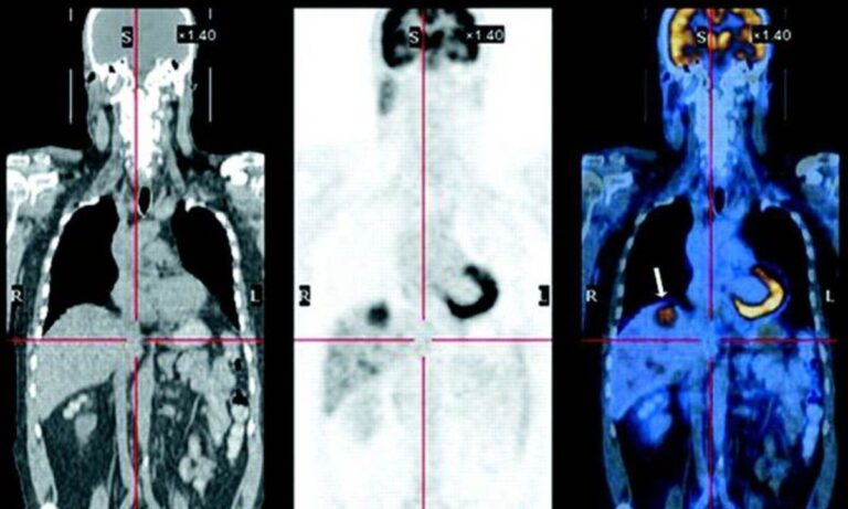 Difference Between a PET and CT Scan